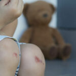 Little girl sitting outside alone with her teddy. Child knees and legs covered with scratches and bruises.